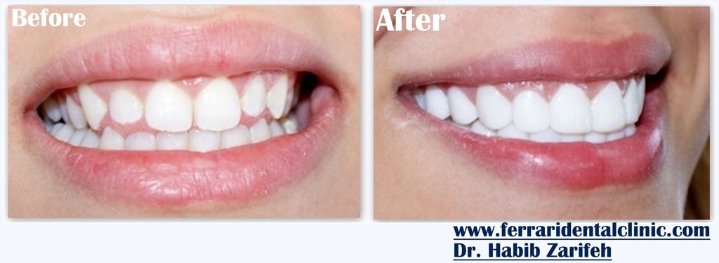 Hollywood smile options and cost in Lebanon Beirut by Elite dentists 